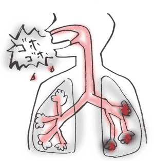 慢性閉塞性肺疾患